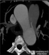 Patent Ductus Arteriosus